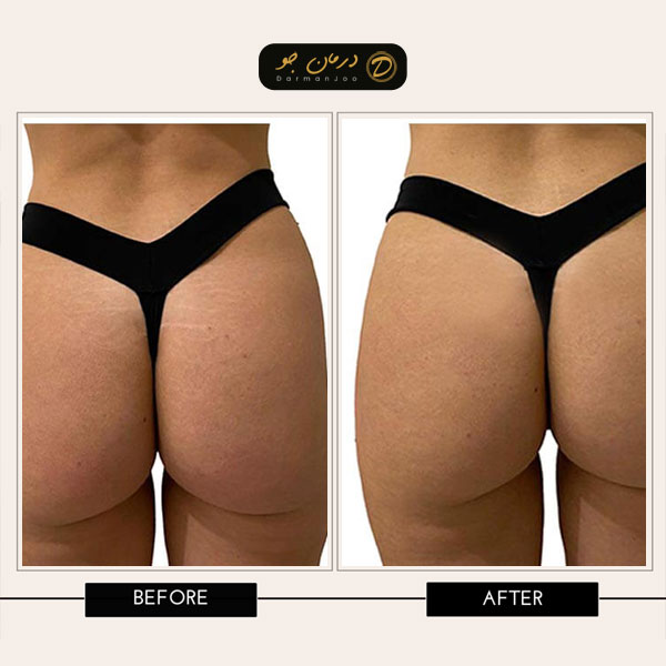فیلر بادی بیکینی 7 فیلر بادی بیکینی قبل و بعد 2