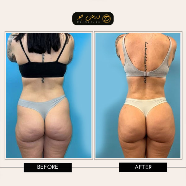 فیلر بادی بیکینی 9 فیلر بادی بیکینی قبل و بعد 3