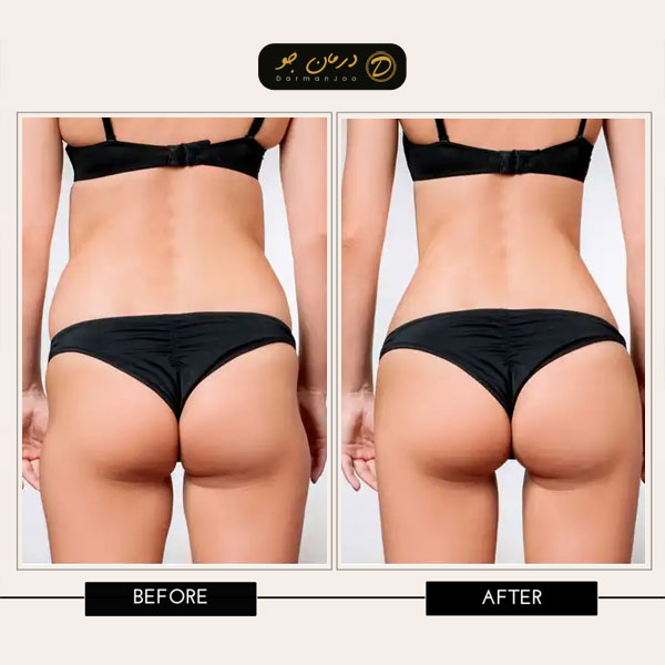 فیلر بادی بیکینی 6 فیلر بادی بیکینی قبل و بعد