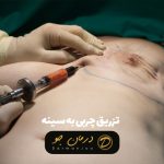 تزریق چربی به سینه