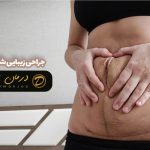جراحی زیبایی شکم