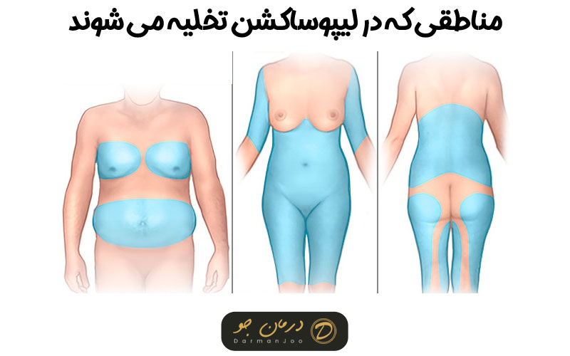 هزینه عمل لیپوماتیک شکم و پهلو 8 هزینه عمل لیپوماتیک شکم و پهلو