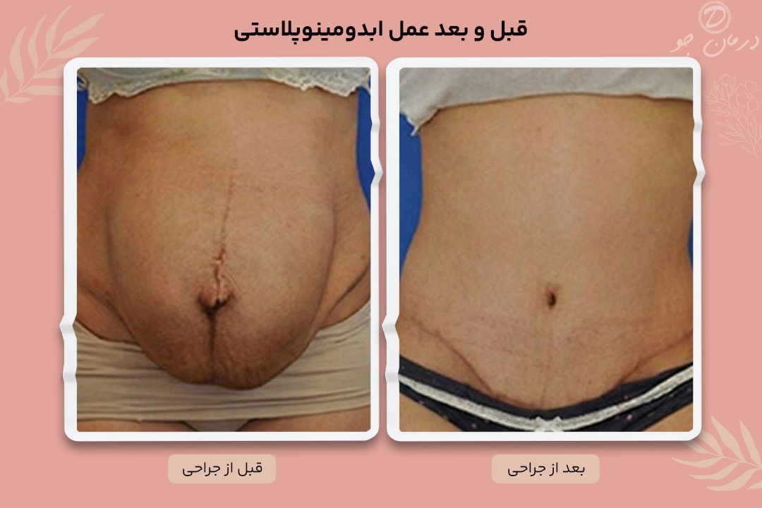 ابدومینوپلاستی 4 عکس بل و بعد عمل ابدومینوپلاستی