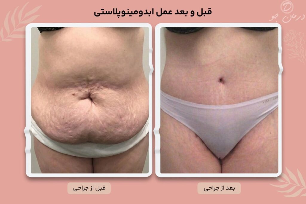 عکس قبل و بعد پیکر تراشی ابدومینوپلاستی