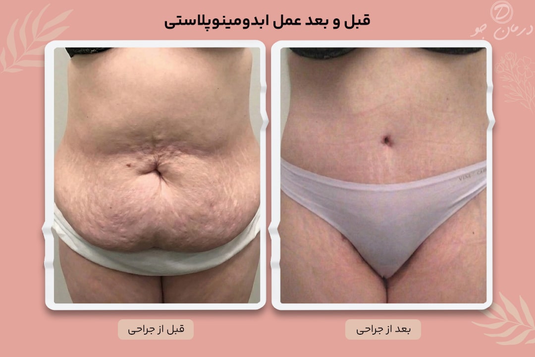 ابدومینوپلاستی 5 عکس قبل و بعد ابدومینوپلاستی