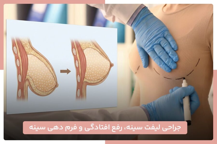 جراحی لیفت سینه
