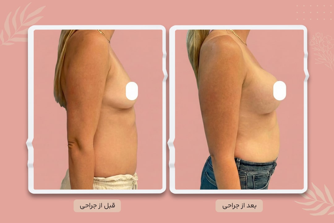 قبل و بعد پروتز سینه