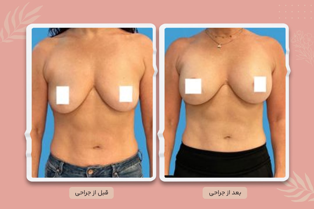 قبل و بعد پروتز سینه