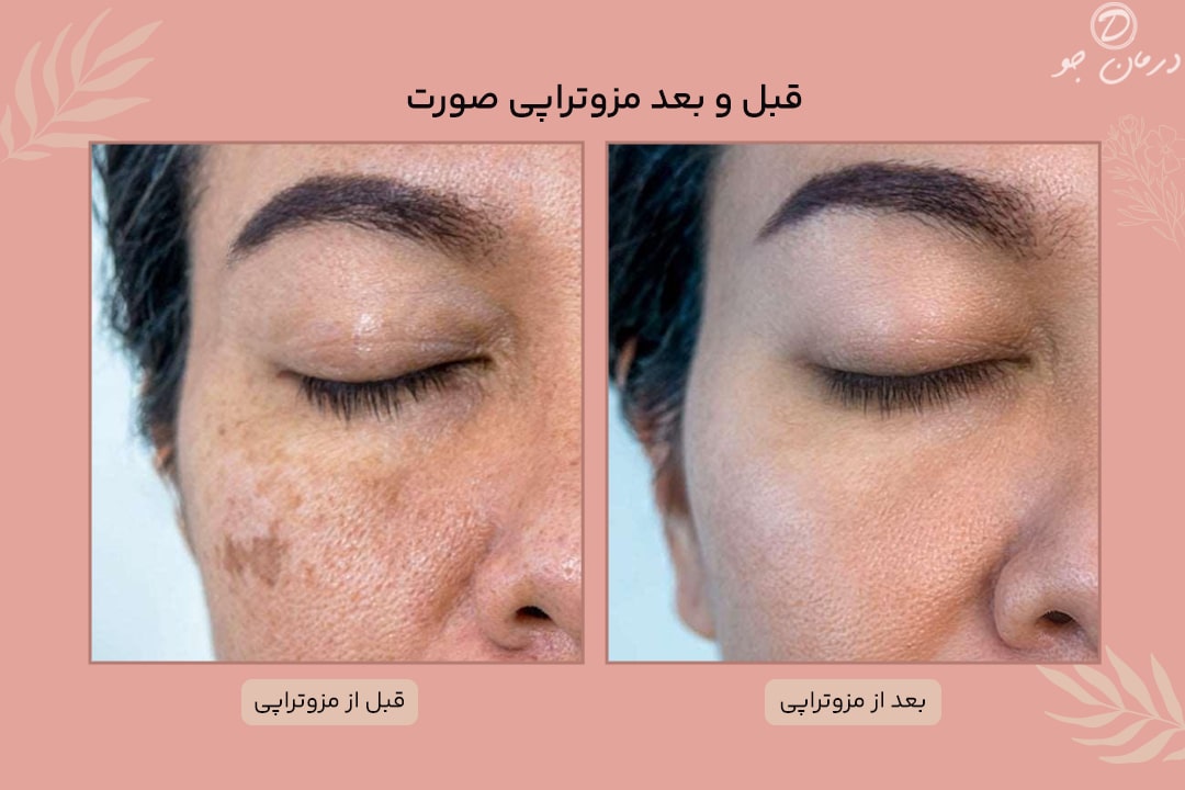 عکس قبل و یعد مزوتراپی