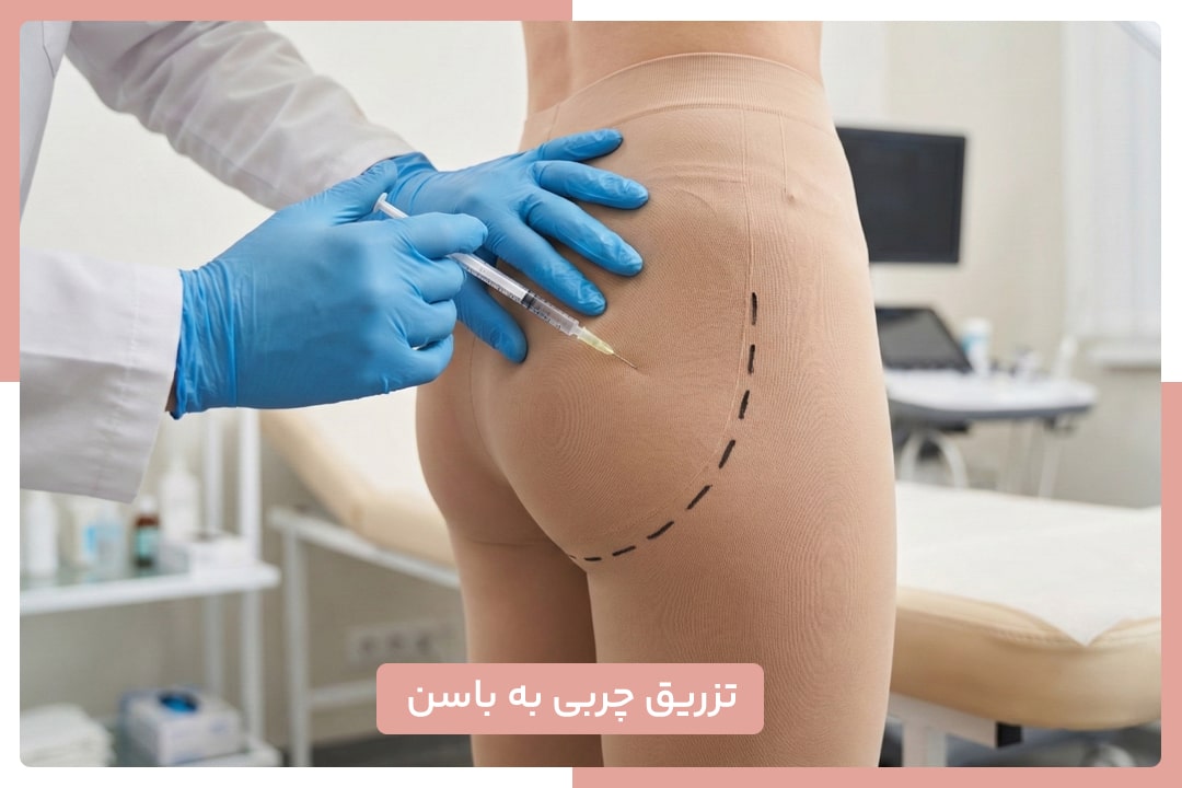 تزریق چربی به باسن
