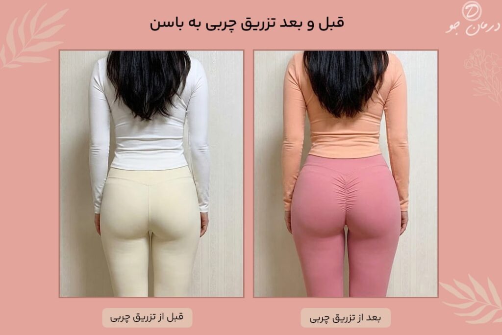 قبل و بعد تزریق چربی به باسن