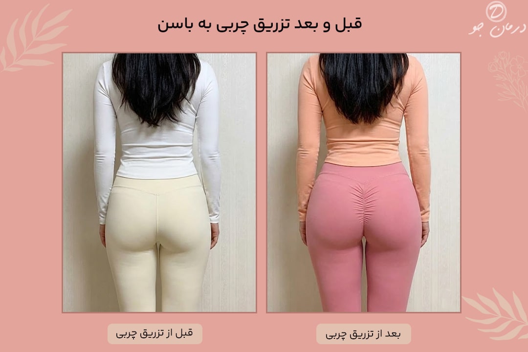 عکس قبل و بعد تزریق چربی به باسن