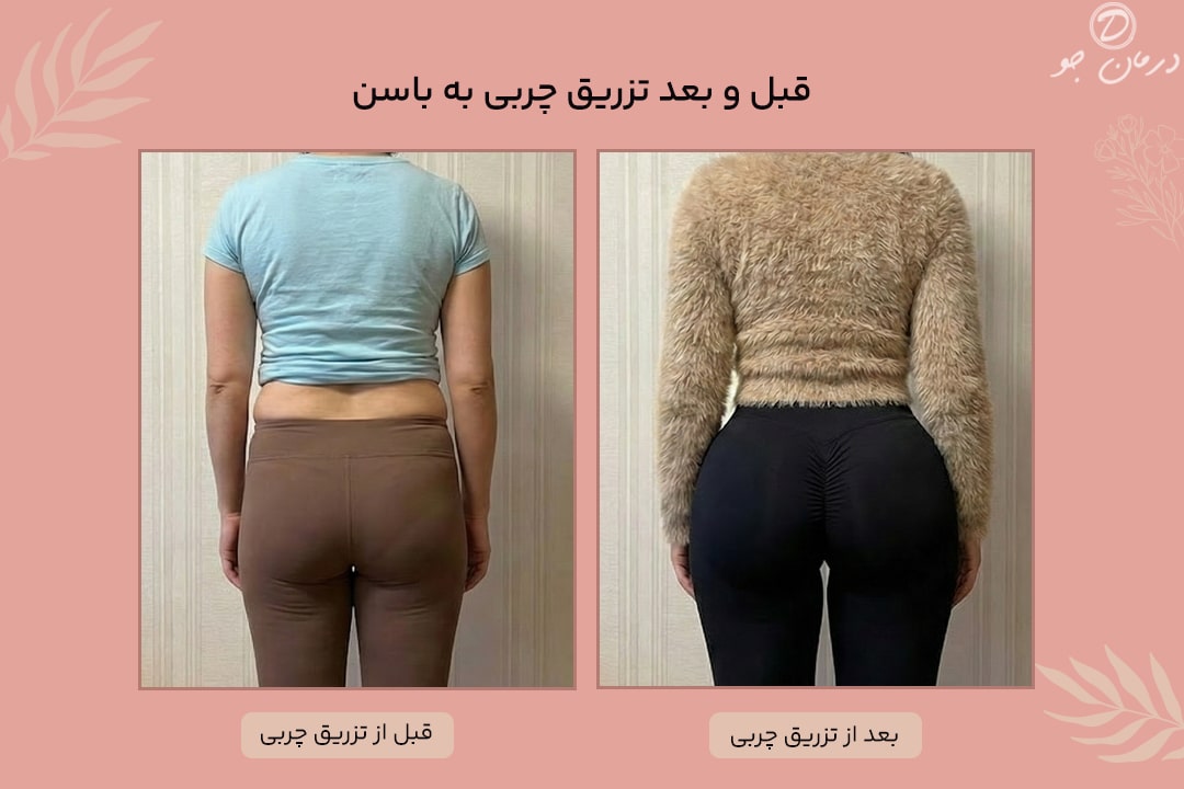 قبل و بعد تزریق چربی باسن