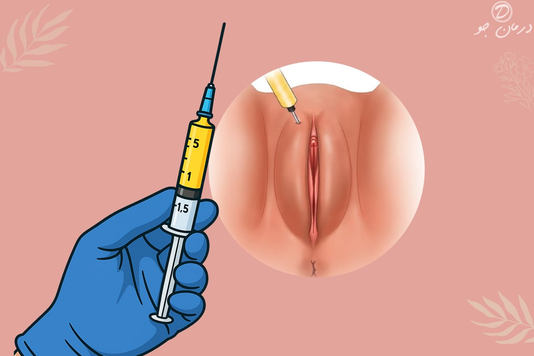 عکس تزریق فیلر به بیکینی