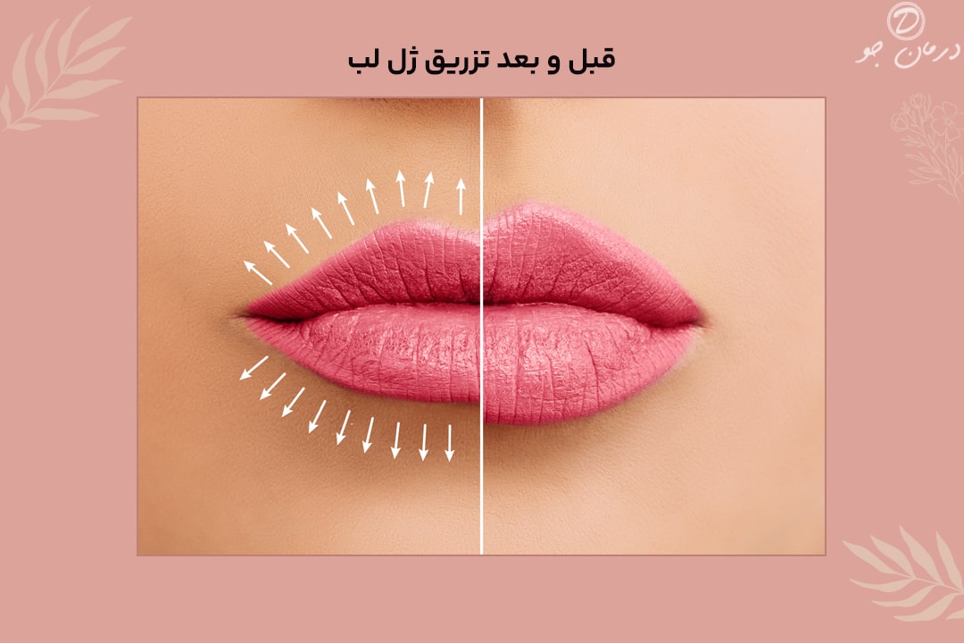 عکس قبل و بعد تزریق ژل