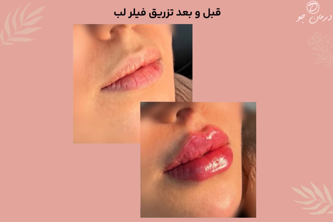 عکس قیل و بعد تزریق فیلر لب