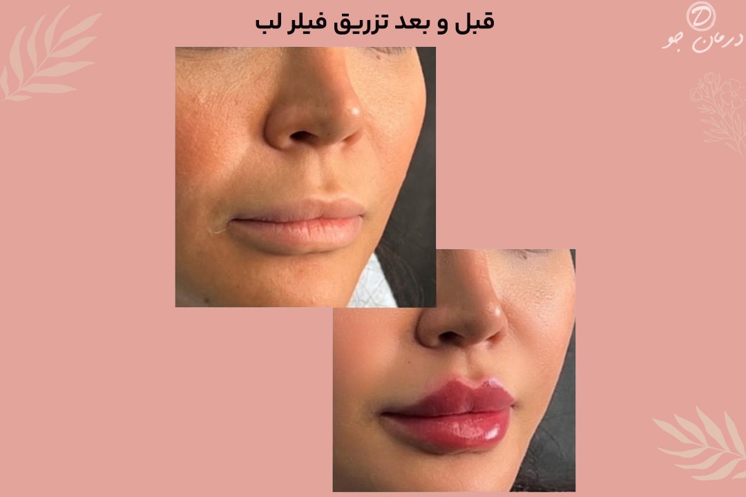 قبل و بعد تزریق فیلر لب