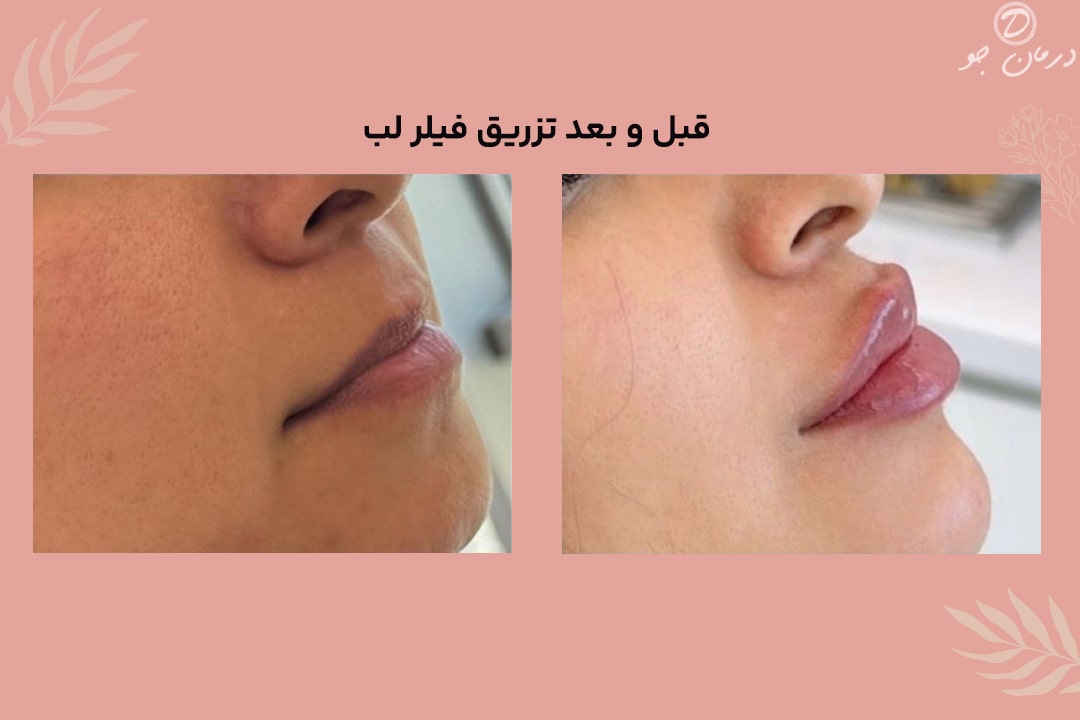 قبل و بعد تزریق فیلر لب