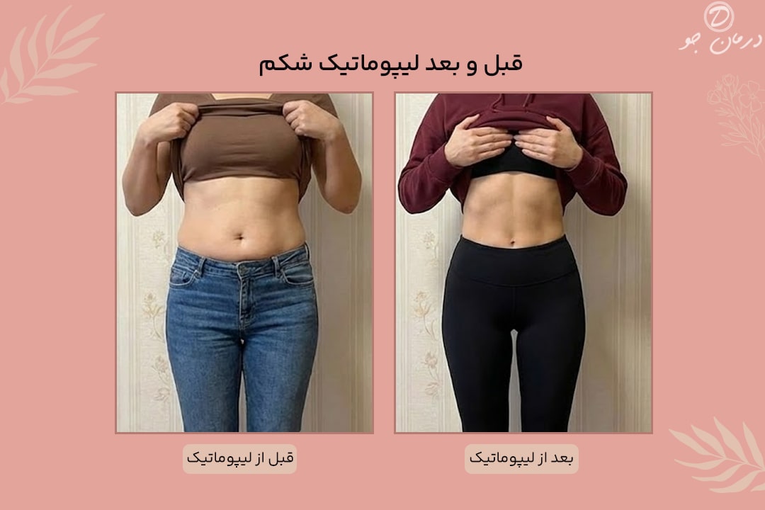 لیپوماتیک 3 قبل و بعد لیپوماتیک