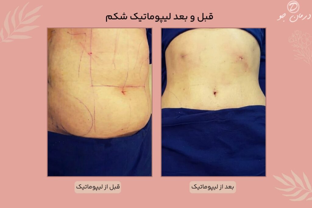 عکس قبل و بعد پیکر تراشی لیپوماتیک