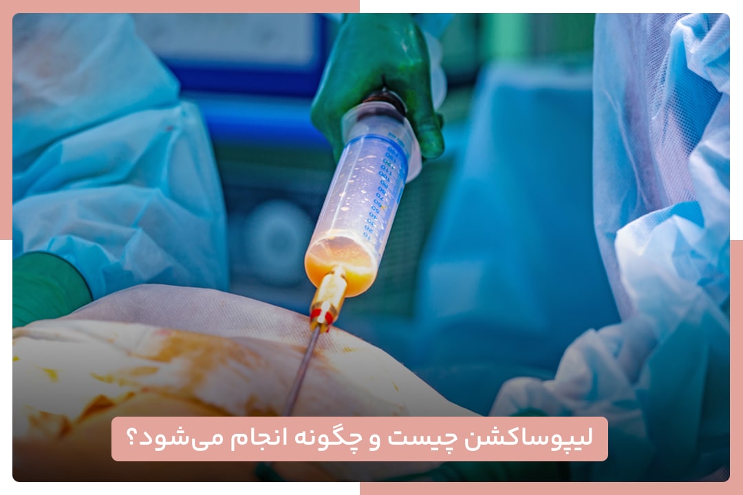 لیپوساکشن