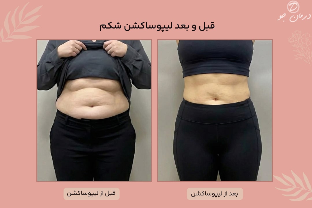 لیپوساکشن 3 عکس قبل و بعد لیپوساکشن