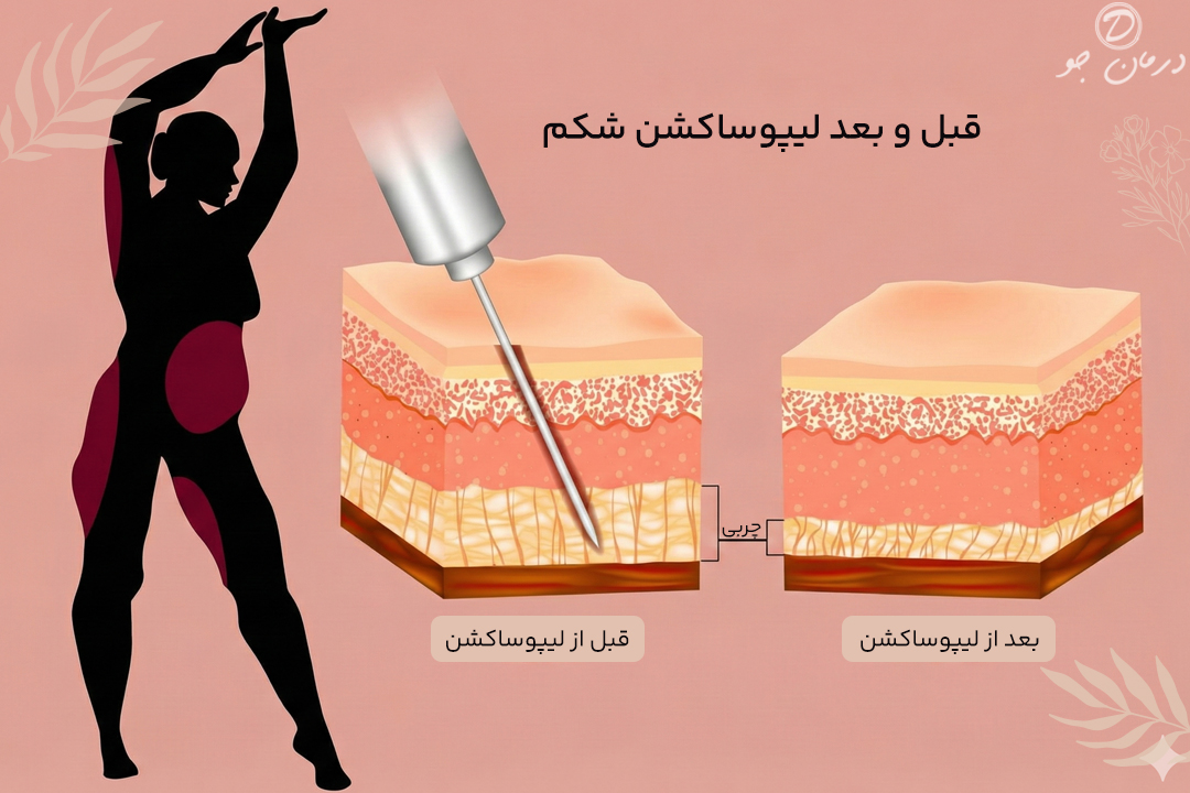 لیپوساکشن 5 قبل و بعد لیپوساکشن شکم