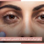 رفع تیرگی دور چشم