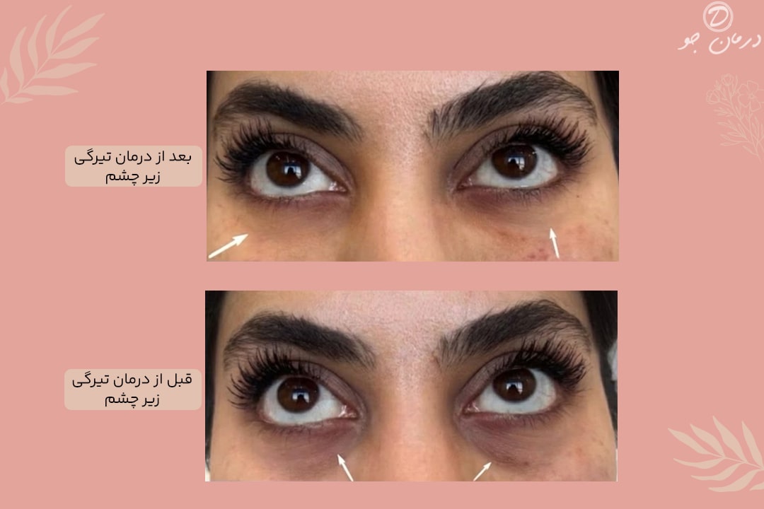 درمان تیرگی زیر چشم