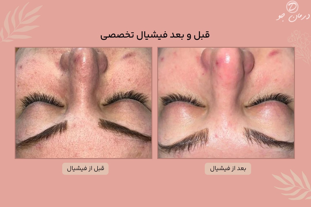 قبل و بعد فیشیال