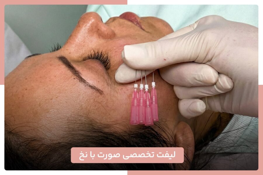 لیفت صورت با نخ