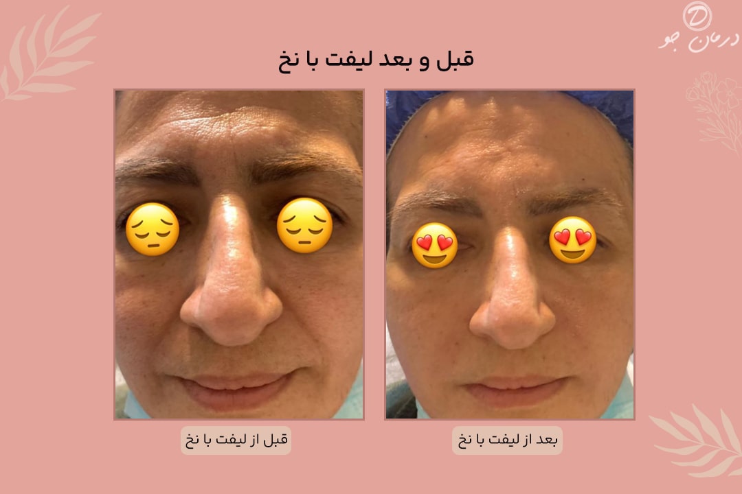 عکس قبل و بعد لیفت صورت با نخ