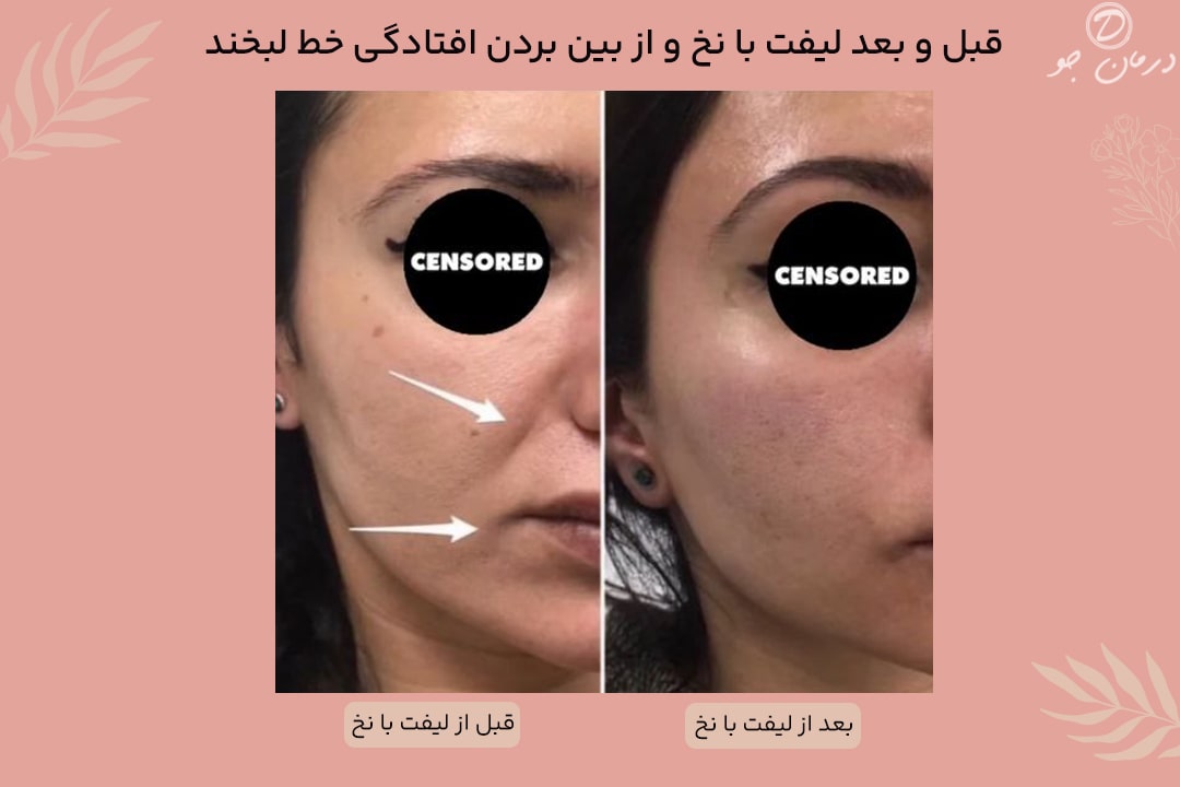 لیفت صورت با نخ برای از بین بردن خط لبخند