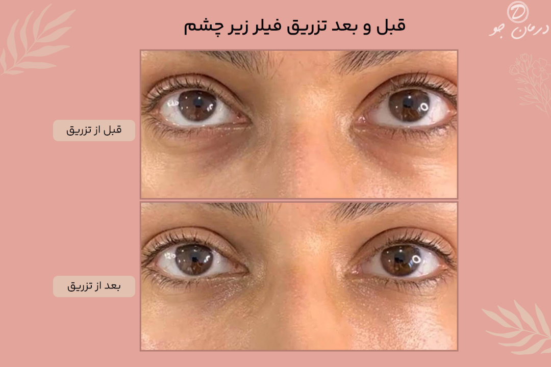 عکس قبل و بعد فیلر زیر چشم