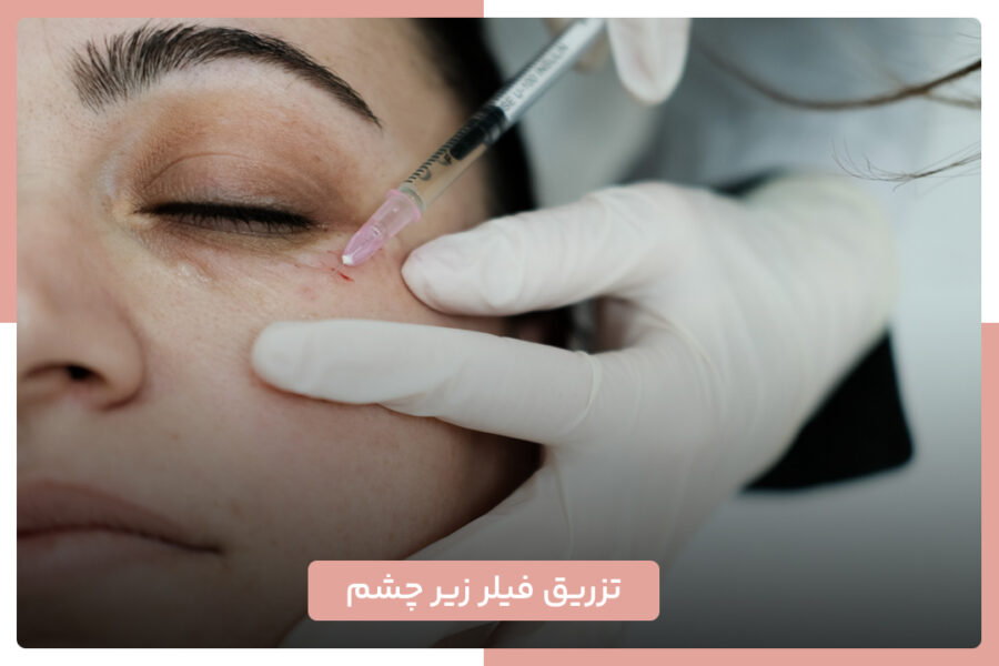 تزریق فیلر زیر چشم