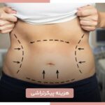 هزینه پیکرتراشی