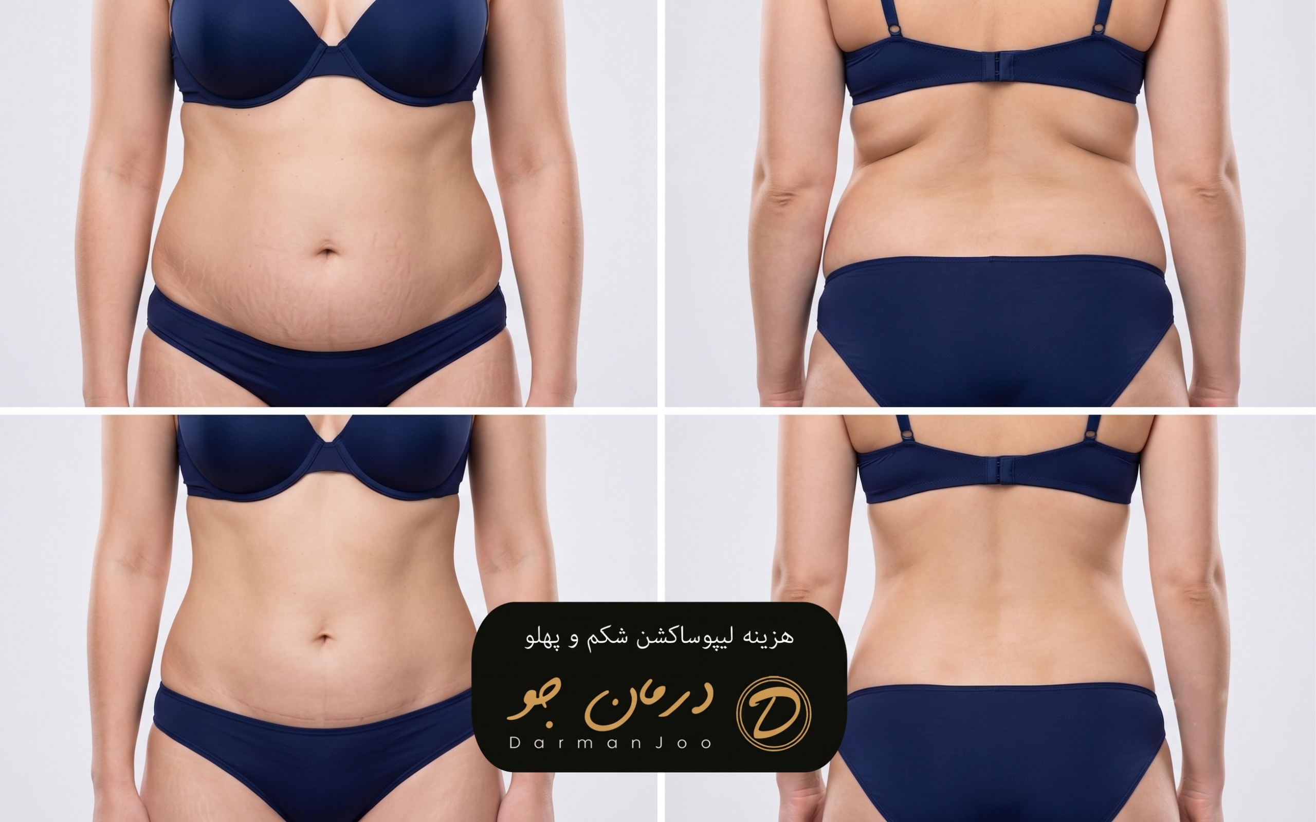 abdominoplasty cost