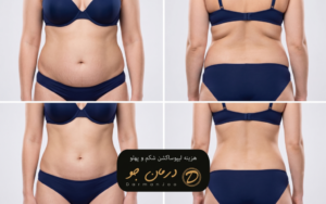 هزینه ابدومینوپلاستی