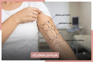Cost of laser hair removal