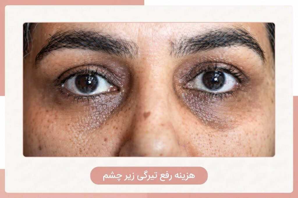 هزینه درمان تیرگی دور چشم 1 هزینه درمان تیرگی دور چشم